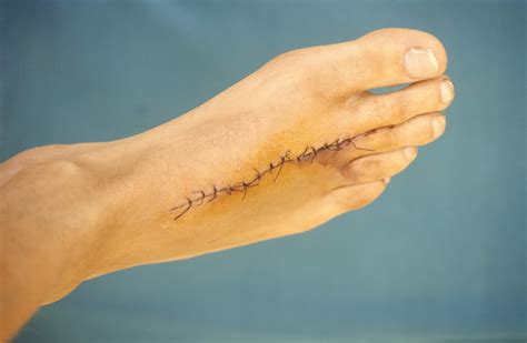 Sutures Answers On Healthtap