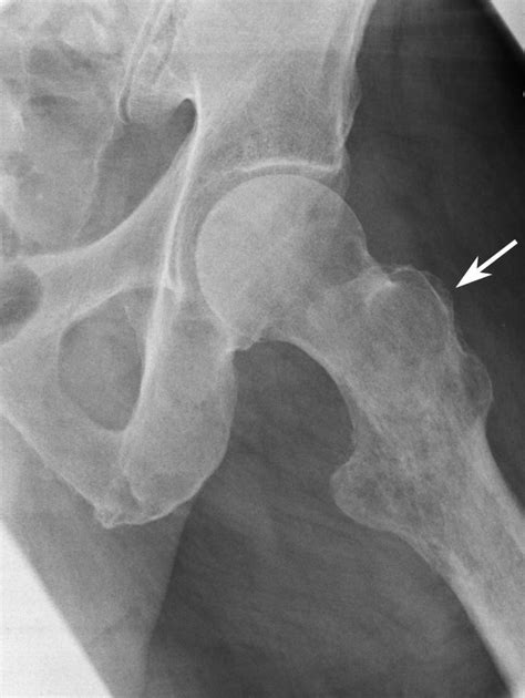 Primary Lymphoma Of Bone Orthoinfo Aaos