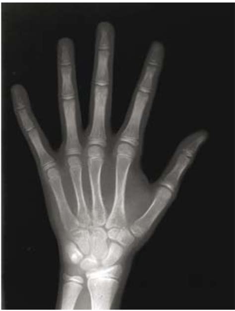 A Posteroanterior Hand Wrist Radiograph From A 10 Year Open I