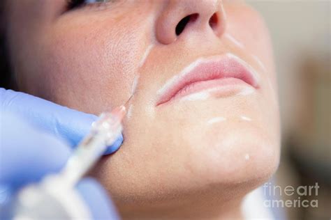 Woman Having Hyaluronic Acid Injections Photograph By Microgen Images Science Photo Library Pixels