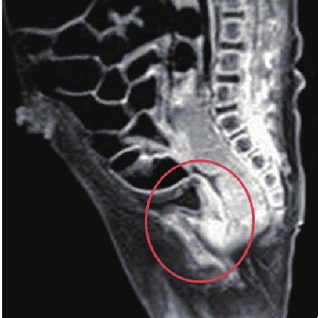 Pelvic Magnetic Resonance Image Shows The Imperforate Anus With A