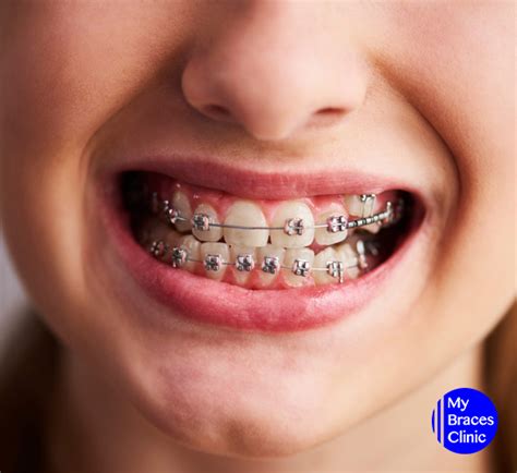 4 Problems You May Face With Orthodontic Solutions And How To Solve