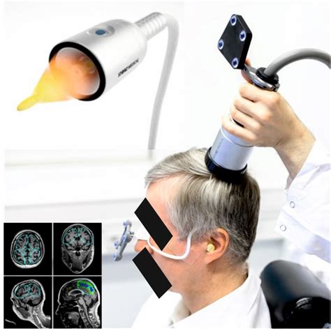 Transcranial Pulse Stimulation With Ultrasound In Alzheimers Disease