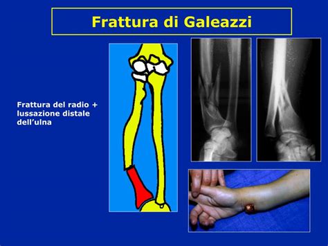 PPT - Fratture avambraccio PowerPoint Presentation, free ...