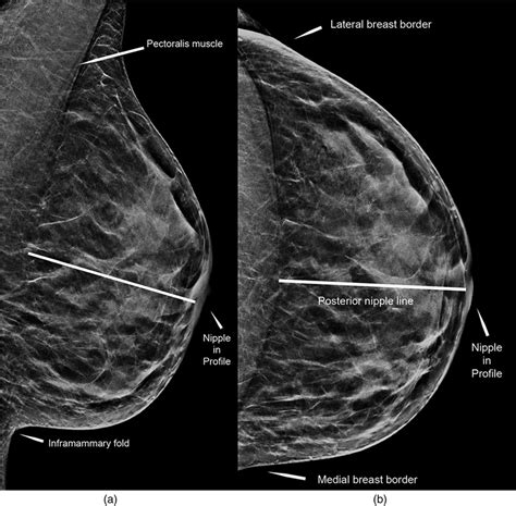 Illustration Of Positioning Criteria Of The Breast A Left MLO View