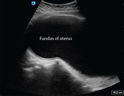 Imperforate Hymen Haematometrocolpus Critical Care Sonography