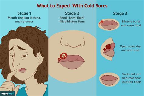 How To Remove A Mouth Ulcer 10 Ways To Get Rid Of Sores Artofit