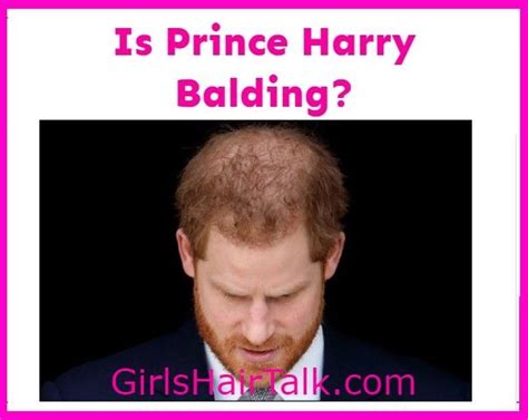 Is Prince Harry Bald What Happened To His Hair In 2022 Prince Harry