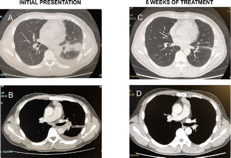 Comparing Ct Scan Thorax At Initial Presentation And At 6 Weeks Of