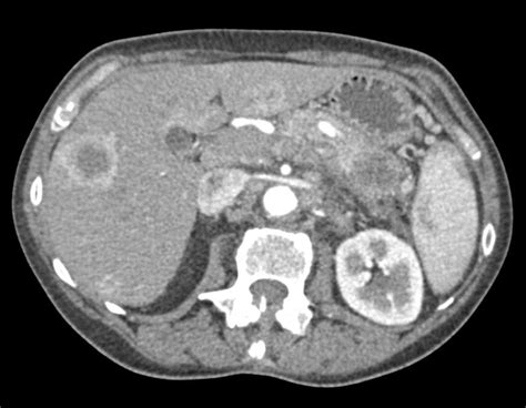Pancreatic Cancer With Liver Metastases Pancreas Case Studies