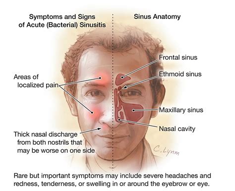 sinusitis types causes symptoms treatment rxharun