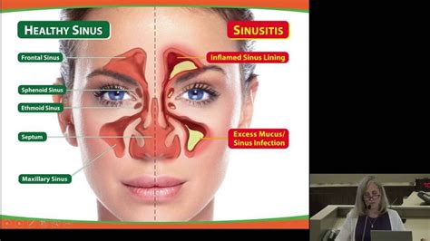 Evaluation And Management Of Acute And Chronic Sinusitis Youtube