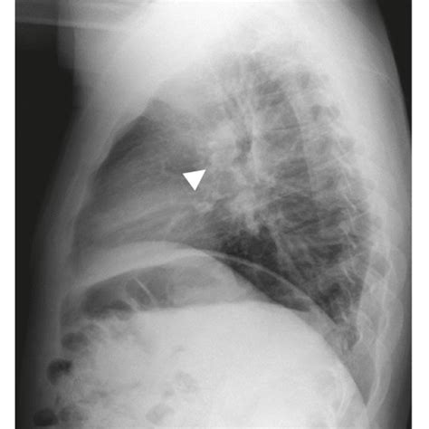 Pa And Lateral Chest Radiographs Obtained 5 Years Earlier A B Show