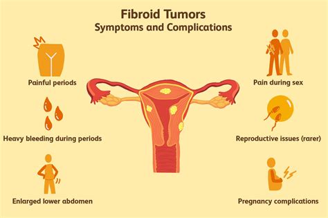 Things To Know Uterine Fibroid Tumors 3522376 5c61cc4a46e0fb0001f08e79
