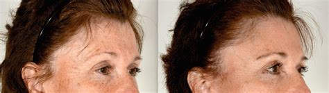 Tired Of Looking Tired Browlift Charleston Facial Plastic Surgery