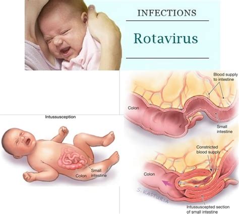 Anak eva, tito pernah mengalami cirit birit yang. Kes Jangkitan Rotavirus Pada Kanak-Kanak