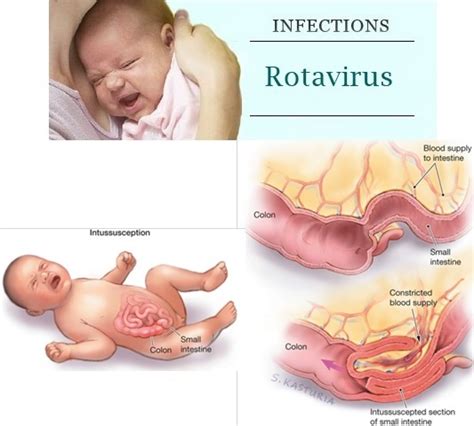 Laktase merupakan sejenis enzim yang terdapat di dalam usus. Kes Jangkitan Rotavirus Pada Kanak-Kanak