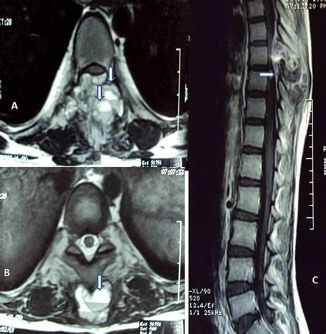 Aneurysmal Bone Cyst Of Thoracic Spine Case Report And Brief Review Of