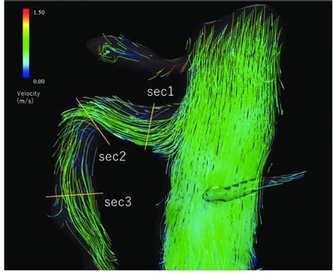 The Streamline Of The SMA Generated From D Flow MRI Of The Y O