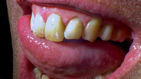 You should never brush your teeth with salt and pepper. I Didn T Brush My Teeth For A Year - TeethWalls