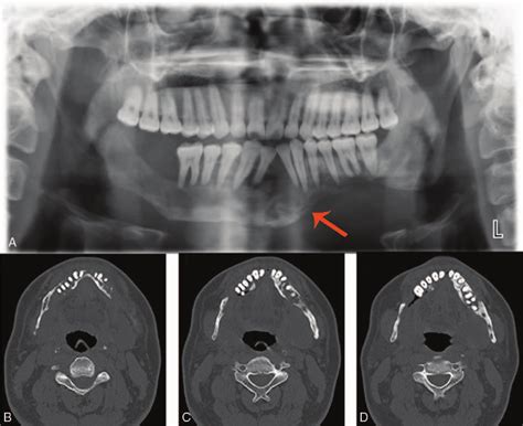Images Of Panoramic Radiograph And Computed Tomography Ct Scan A