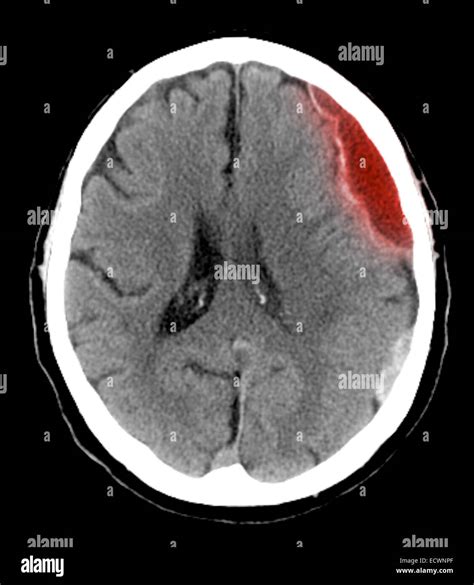 Subdural Hemorrhage CT Scan