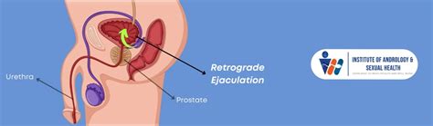 Retrograde Ejaculation Causes Symptoms Treatment Iash
