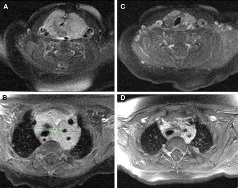A Axial T1 Images From Mri With Gadolinium Contrast At The Level Of