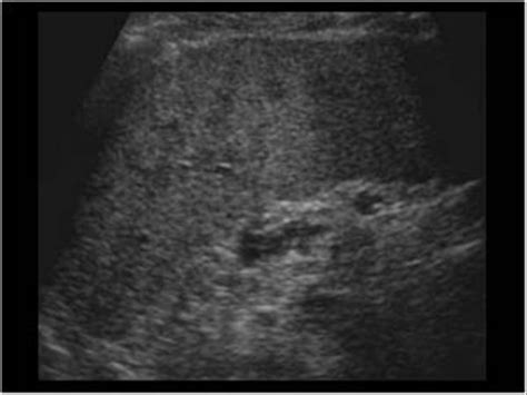 Abdomen And Retroperitoneum 14 Spleen Case 142 Benign Mass