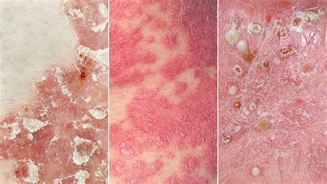 Types Of Psoriasis Everyday Health