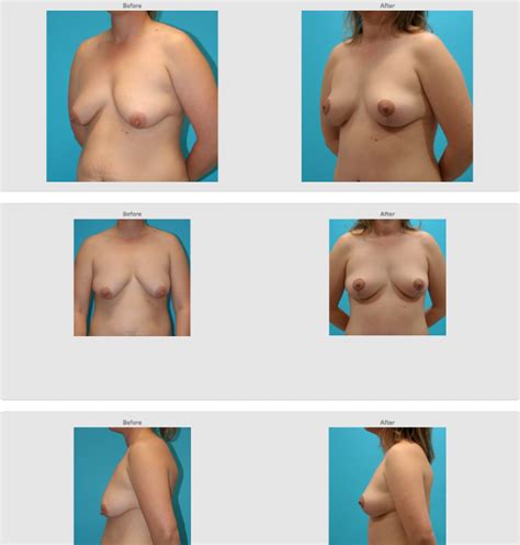 Breast Lift Reduction Holzapfel Lied Plastic Surgery