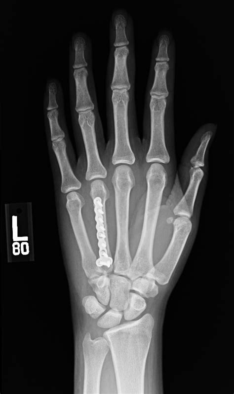 5th Metacarpal Base Fracture