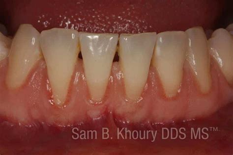 Gum Grafts Before And After Dr Sam Khoury