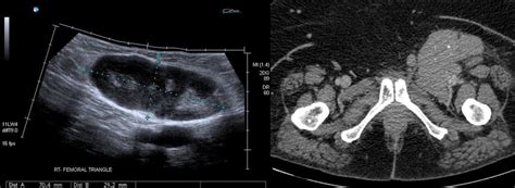 Lymphadenopathy Long Axis Panoramic Ultrasound Image Left Of A