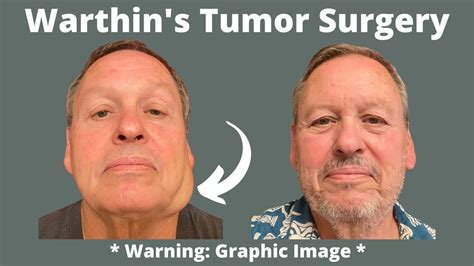 Warthins Tumor Having The Tumor Removed From My Face Youtube