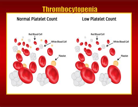 Wellscript Llc Thrombocytopenia Low Platelet Counts
