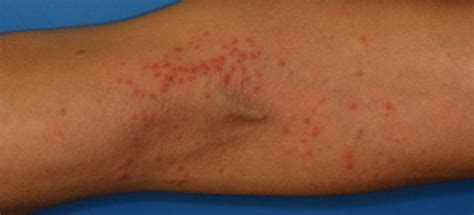 Atopic Dermatitis And Skin Symptoms Rash Pictures Treatment Center