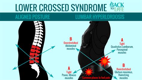 Lower Crossed Syndrome Condition Characterised By Muscle Imbalances Of The Low Back The Core