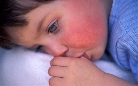 Scarlet Fever Is Back And You Need To Know The Signs Goodfullness