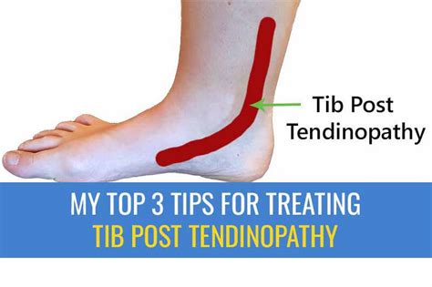 My Top Tips For Treating Tibialis Posterior Tendinopathy Sports