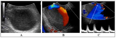 Ultrasound Image B Mode A Color Doppler Mode B And Pulsed