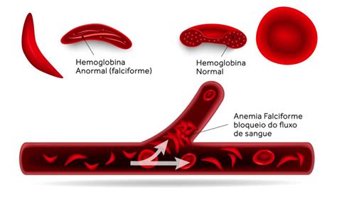 A Eletroforese De Hemoglobina No Diagnóstico De Anemia Falciforme Agd