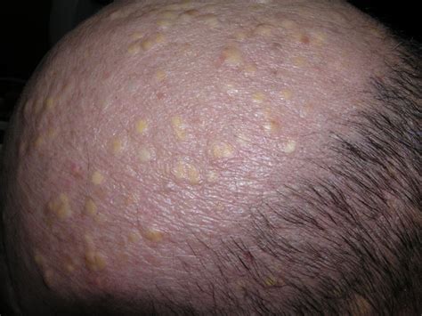 Multiple Pilar Cysts On Scalp Pilar Cyst Of The Scalp Open I I Will