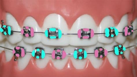 follow ya average girl for more pins ♛ braces colors cute braces colors cute braces