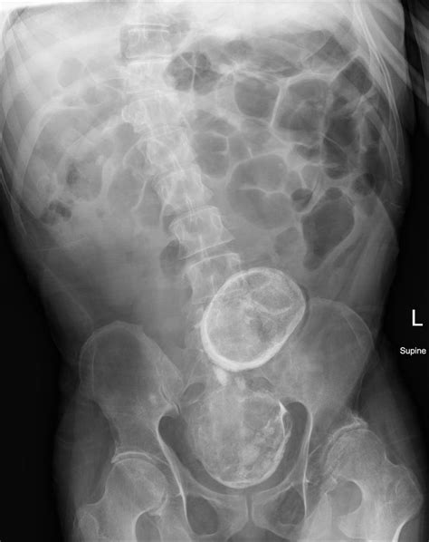 Faecolith Radiology Case Radiology Radiology