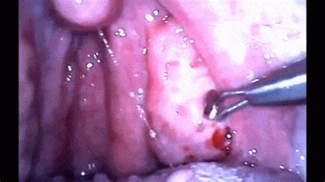 Tonsil stones, also known as tonsilloliths, are formed when debris becomes trapped in pockets (sometimes referred to as crypts) in the tonsils. See Here: This Will Make You Never Want To Visit The ...