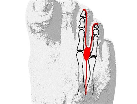 If you have a morton's neuroma, you may have one or more of these symptoms where the nerve damage is occurring Morton Neurom bei Läufer - Darum laufe ich
