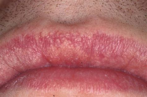 Fordyce Spots Can Be Treated Naturally By Apple Cider Vinegar