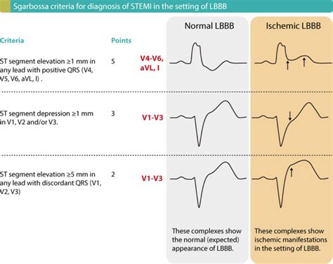 Stemi St Elevation Myocardial Infarction Diagnosis Criteria Ecg