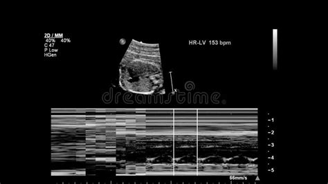 Ultrasound Examination Of The Fetal Heart Stock Illustration